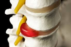 One of them might work for you. Posterior Disc Bulge Vs Herniated Disc