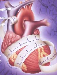 Existen una serie de alteraciones secuenciales en el tiempo: Infarto Sem Dor Existe Mesmo Cardiologia Pro