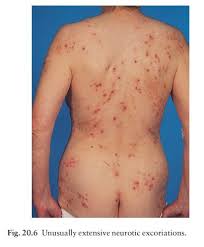 Image result for Neurotic Excoriation