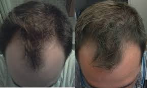 Feel free to discuss hair loss remedies use the following search parameters to narrow your results: Hair Loss Forum Using A Product Called Zx42