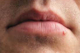 What is the difference in symptoms and appearance of genital herpes versus an ingrown hair? Cold Sore Vs Pimple Differences Similarities And Treatment