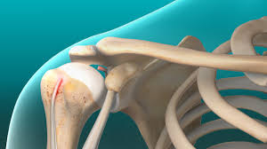 The biceps muscle is located at the front of your upper arm. Biceps Tendon Tear At The Shoulder Shoulder Surgeons In Washington D C Maryland And Northern Virginia