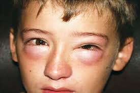 Image result for Anaphylaxis
