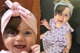 Su delno dydžio pigmentine dėme gimusios mažylės laukia 7 sunkios  operacijos