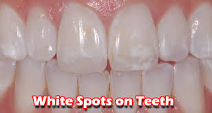 Having white spots on your teeth can be undesirable, but they are rarely a serious medical concern. How To Get Rid Of White Spots On Teeth Rvcj Media
