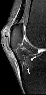 Muhammad bin zulfiqar from image.slidesharecdn.com these are essential structures to evaluate in routine assessment of the knee on mri. Layered Approach To The Anterior Knee Normal Anatomy And Disorders Associated With Anterior Knee Pain Radiographics