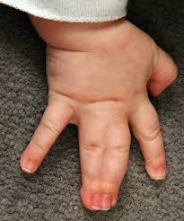 Image result for Syndactyly