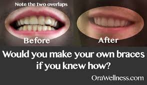 One young college student in new jersey made his own diy invisalign by printing out tooth. Would You Make Your Own Braces If You Knew How Orawellness