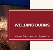 Welding Burns: Causes, Treatment, and Prevention
