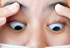 Image result for melanosis sclera