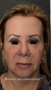 #cirurgiaplástica #liftingfacial