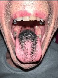 Image result for black hairy tongue symptoms