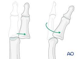 Image result for Lateral PIP Dislocation