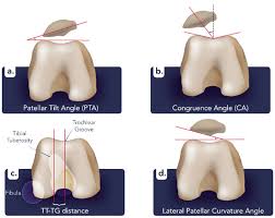 Image result for Patellar Tilt Test