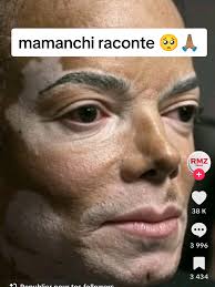 Comprendre le vitiligo à travers Michael Jackson et Axel Mary