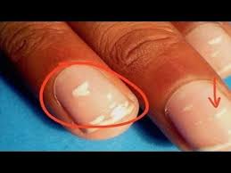 What Causes White Spots On Nails Most People Wind Up With White Spots On Their Nails At One Point Or Nail Fungus Treatment Nail Fungus Remedy Nail Fungus Cure