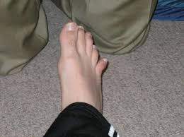 I stubbed my toe last night. Toe Fracture Broken Toe Atlanta Ga Dr Dominic Carreira