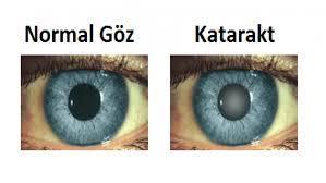 More and more proteins gather. Katarakt Nedir Ozel Meltem Hastanesi