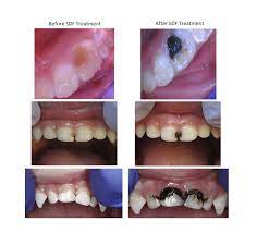 Silver Diamine Fluoride In Las Vegas Nv A Childrens Dentist