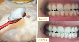 Huile de ricin cheveux avant après: En Video Une Recette Naturelle Pour Fabriquer Votre Dentifrice Chez Vous Newsmag Dents Huile De Coco Huile De Noix De Coco Huile De Coco