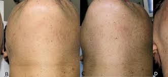 Image result for Hypertrichosis