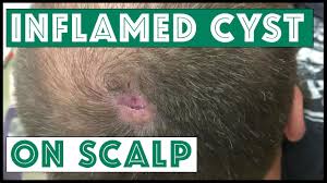 I have 2 (hopefully benign) cysts on my head and have. Is This A Cyst On The Scalp To Be Continued Youtube
