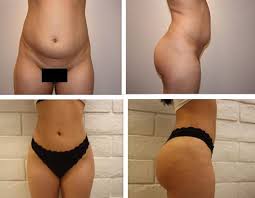 Liposuction And Brazilian Buttlift Bbl With Dr Kenneth Hughes Plastic Surgeon In Los Angeles A Brazilian Buttlift Brazilian Buttlift Surgery Liposuction
