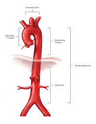 The goal of treating an aortic aneurysm is to prevent dissection or rupture, the likelihood of which increases with the size of the aneurysm. Aortic Aneurysm Uab Medicine