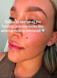 Mole Shave Healing Process