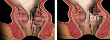 On peut ainsi distinguer : La Chirurgie Des Hemorroides A Eviter