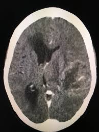 Pin By Pankaj Kaira On Radiology Interesting Cases And Spotters In 2020 Radiology Celestial Celestial Bodies