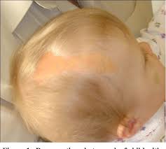 Nevus sebaceus or sebaceous nevus (the first term is its latin name, the second term is its name in english; A Child With A Congenital Epidermal Nevus Epilepsy And Developmental Delays Linear Nevus Sebaceous Syndrome Semantic Scholar