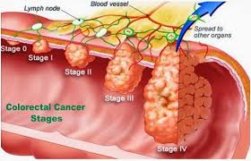 Colon polyps are growths on the lining of your colon or large intestine, part of your digestive tract. Know More Colorectal Colon Cancer Southlake General Surgery