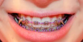Waktu yang diperlukan untuk meratakan gigi dengan menggunakan. Pakai Braces Akhirnya