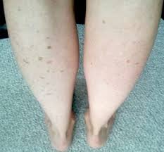 Image result for liver spots on legs