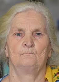 Frontal view of a patient with Figure 2. Lateral view of a patient with... 