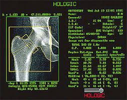 Measuring Bone Health