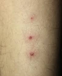 Image result for Pathergy