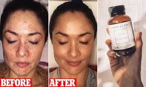 Optimum nutrition is legendary for both quality and innovation. Jshealth Vitamins How To Banish Acne In Three Weeks Daily Mail Online
