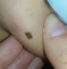 What does melanoma look like? Just Realized How This Awfully Looks Like Melanoma Red Spot Next To It Is A Mosquito Bite My Dermatologist Said To Come Back In Six Months To Check It Again What Are