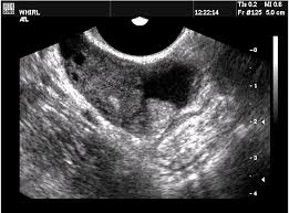 Image result for corpus luteum sonography)