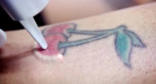 You can also mix honey, aloe vera, salt, and yogurt to create a paste that will help with natural tattoo removal in a similar way to plain aloe vera. 8 Easiest Remedies To Remove Skin Tattoo Pouted Com