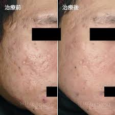 フラクショナル co2 レーザー 10 回目