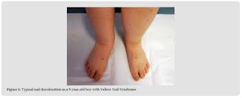Image result for Yellow nail syndrome feet