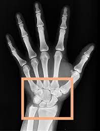 Learn to tell a broken vs sprained wrist with guides on symptoms to watch out for, and detailed information on the most common types of wrist this can make it feel ambiguous in diagnosing your wrist injury and knowing how to move forward with treatment. Wrist Fracture Or Sprain