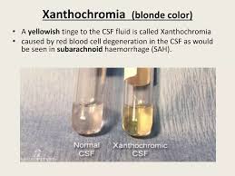 Image result for Cerebrospinal Fluid Color