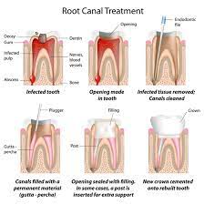 If you are receiving treatment in two appointments, the first appointment is usually to clean and shape the internal tissues of the tooth by drilling, filing and. Root Canal Treatment Procedure