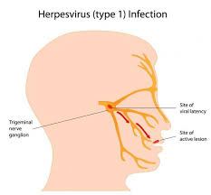 Oral herpes is a viral infection mainly of the mouth area and lips caused by a specific type of the herpes simplex virus. Herpes Simplex Virus Hsv 1 And Hsv 2 Npc
