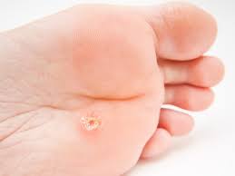 Ketuat plantar disebabkan oleh jangkitan hpv di lapisan luar kulit pada tapak kaki anda. Cara Hilangkan Ketuat Nasi