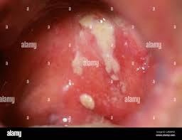 Image result for Oral herpes roof of mouth